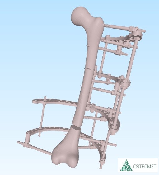 ТМ OSTEOMET Апарат Ілізарова в комплектації СТЕГНО